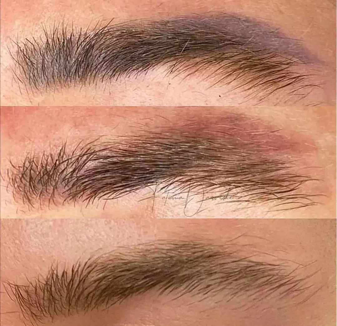 ریموو(پاک کردن تاتو) صورت وبدن با لیزر پیشرفته|خدمات آرایشگری و زیبایی|تبریز, |دیوار