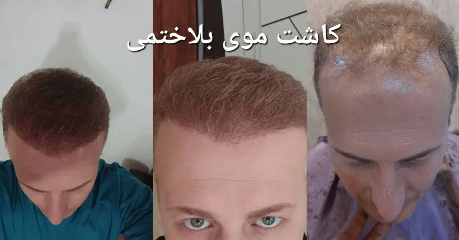 کاشت مو و ابرو طبیعی + پرداخت قسطی|خدمات آرایشگری و زیبایی|ارومیه, |دیوار