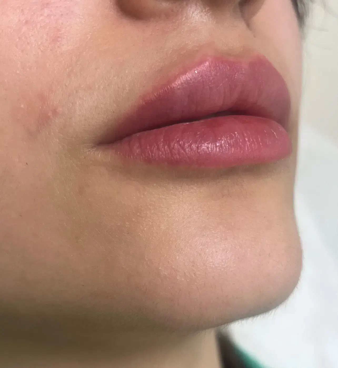 مدل برای ژل لب،گونه و چانه(تزریق توسط پزشک )|خدمات آرایشگری و زیبایی|لاهیجان, کوی خزر|دیوار