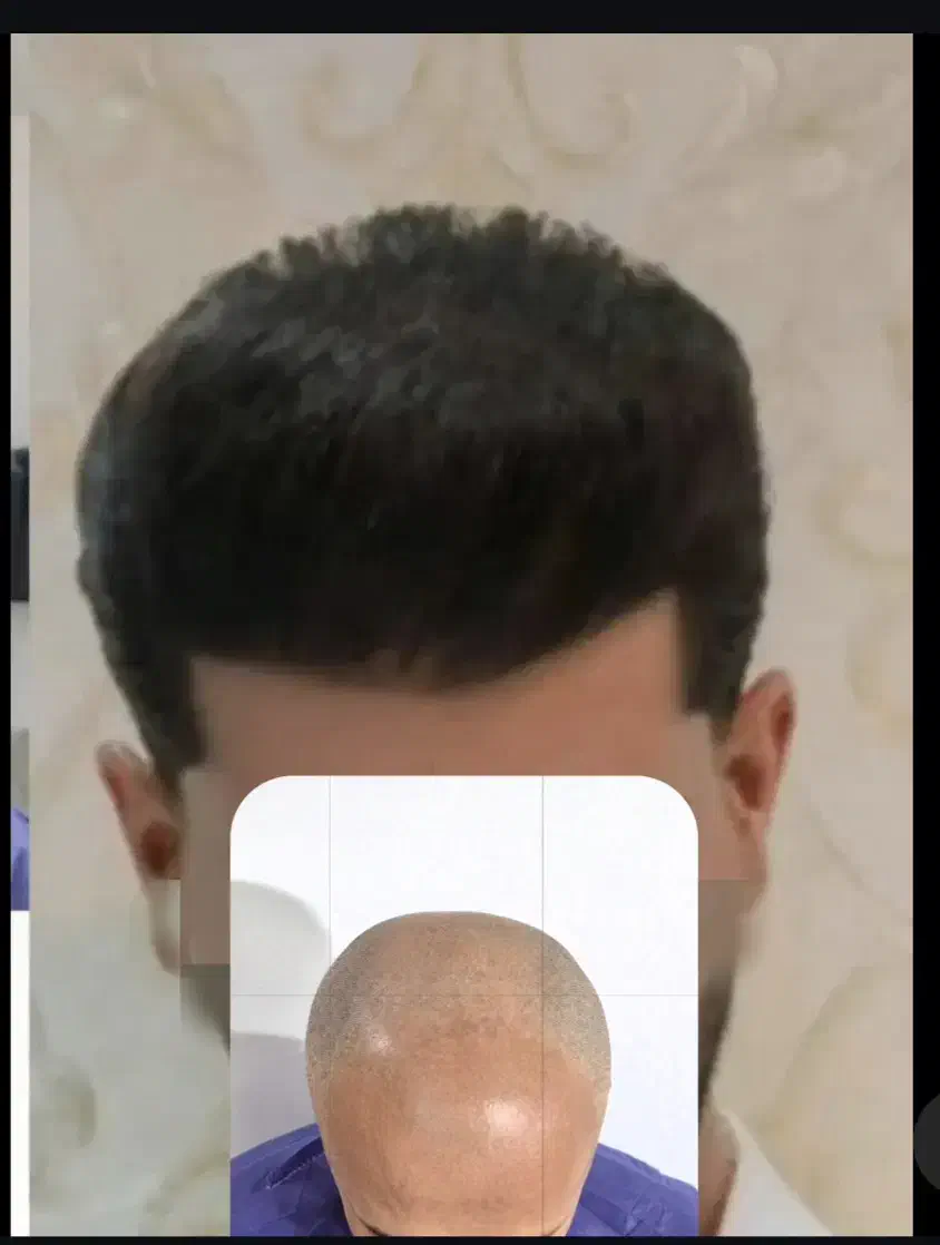 کاشت موی شیرازی|خدمات آرایشگری و زیبایی|مریوان, |دیوار