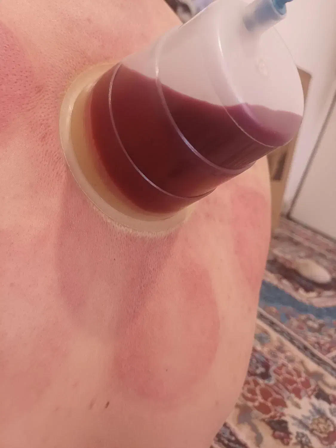 حجامت معجزه میکنه|آرایشی، بهداشتی، درمانی|بندر کنگان, |دیوار