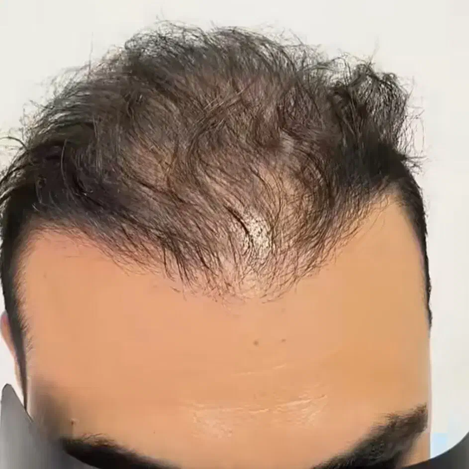 پرپشتی مو در سه روز بدون کاشتمو|خدمات آرایشگری و زیبایی|جهرم, |دیوار