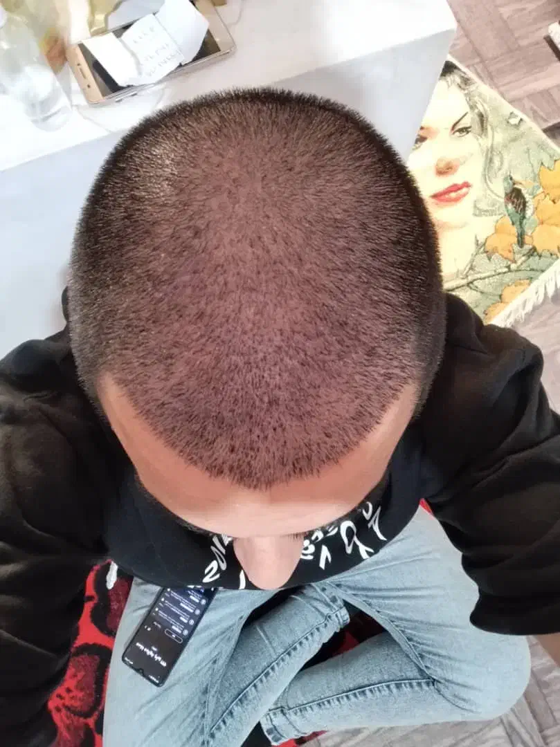 کاشت مو ابرو به بروز ترین با شرایط پرداخت اقساطی|خدمات آرایشگری و زیبایی|تبریز, |دیوار