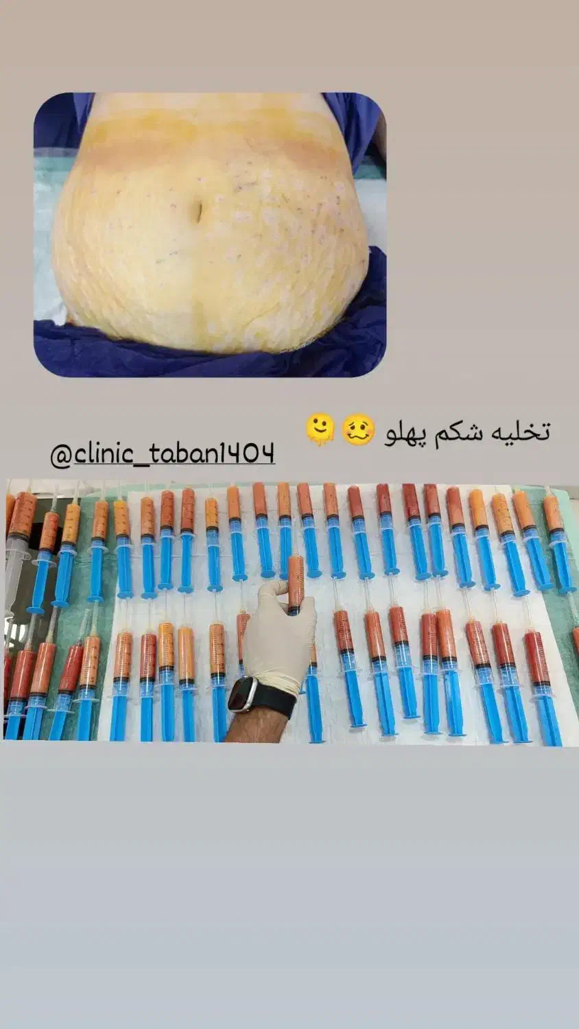 ساکشن وجراحی غبغب|خدمات آرایشگری و زیبایی|کوهدشت, |دیوار