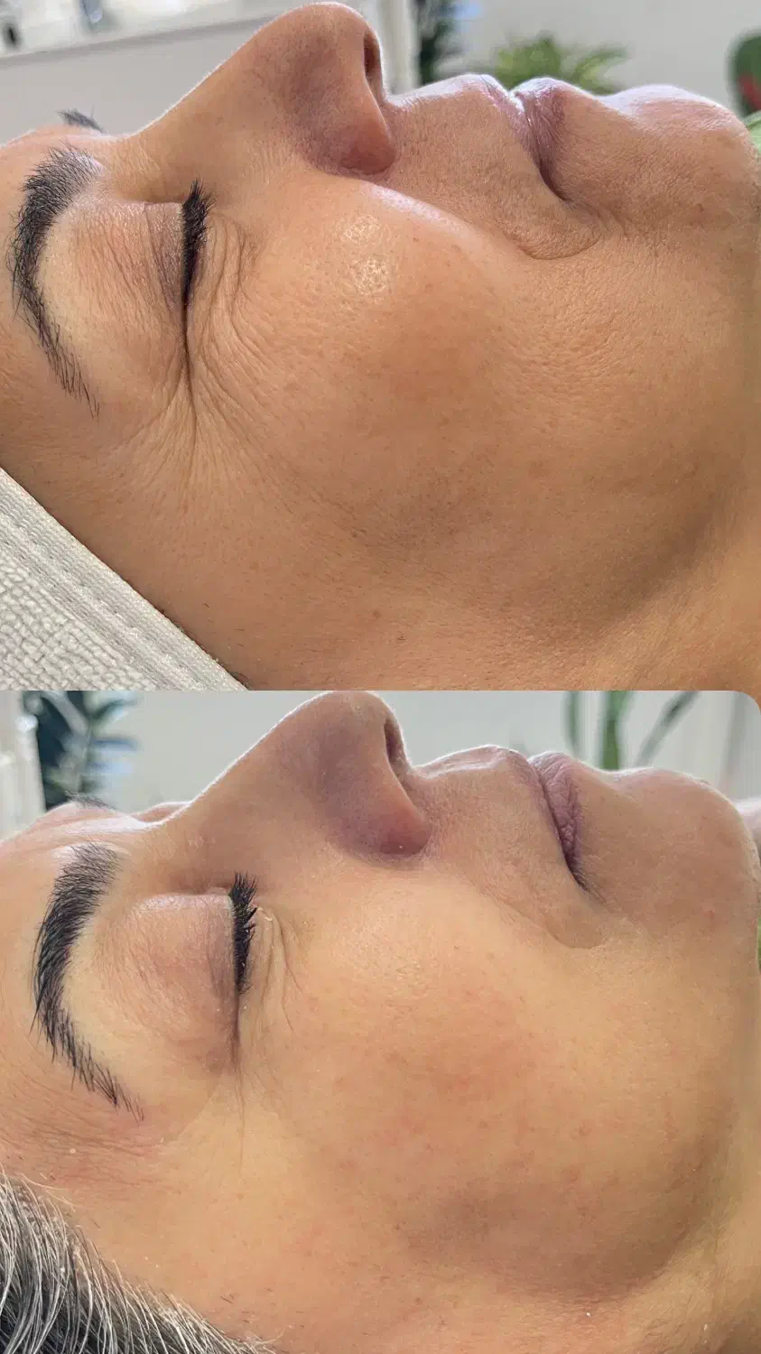 فیشیال تخصصی و درمانی پوست|خدمات آرایشگری و زیبایی|آمل, |دیوار