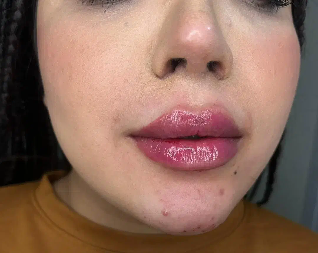 ژل و بوتاکس|خدمات آرایشگری و زیبایی|بجنورد, |دیوار