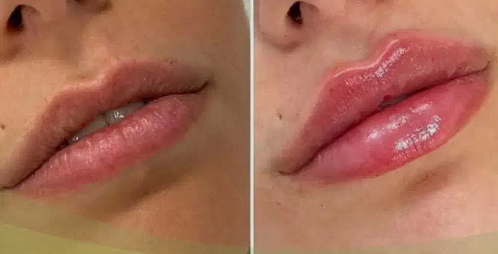 ژل بوتاکس|خدمات آرایشگری و زیبایی|جیرفت, |دیوار