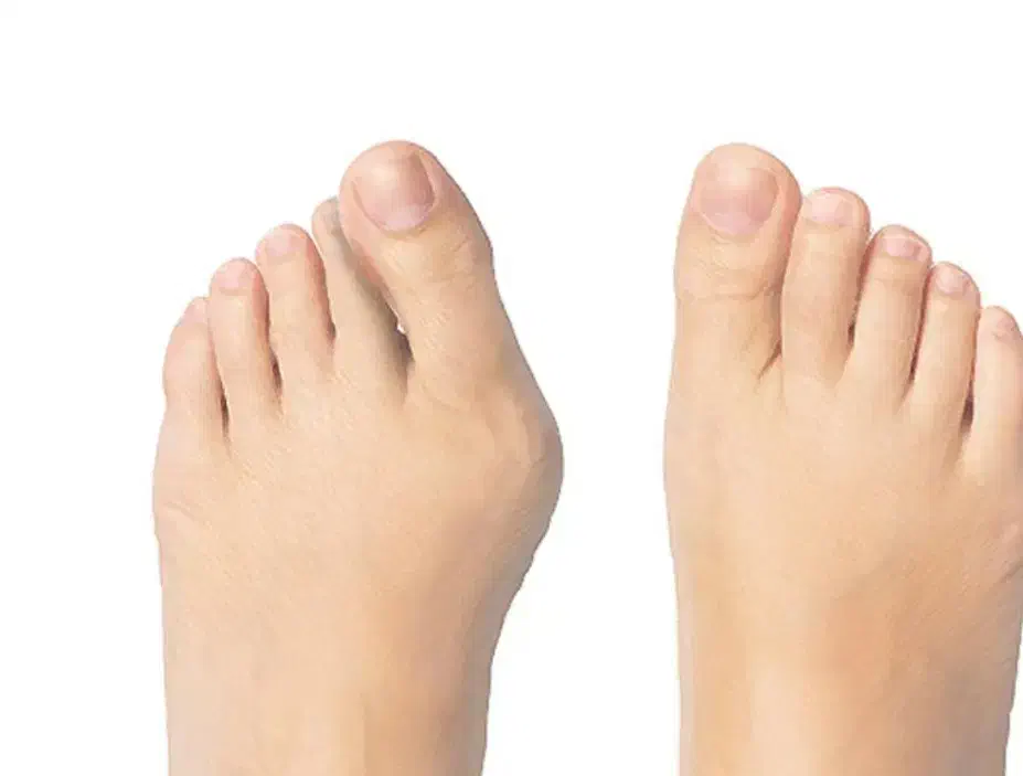 کلینبک درمان هالوکس والگوس (شصت پای کج)|خدمات آرایشگری و زیبایی|قروه, |دیوار