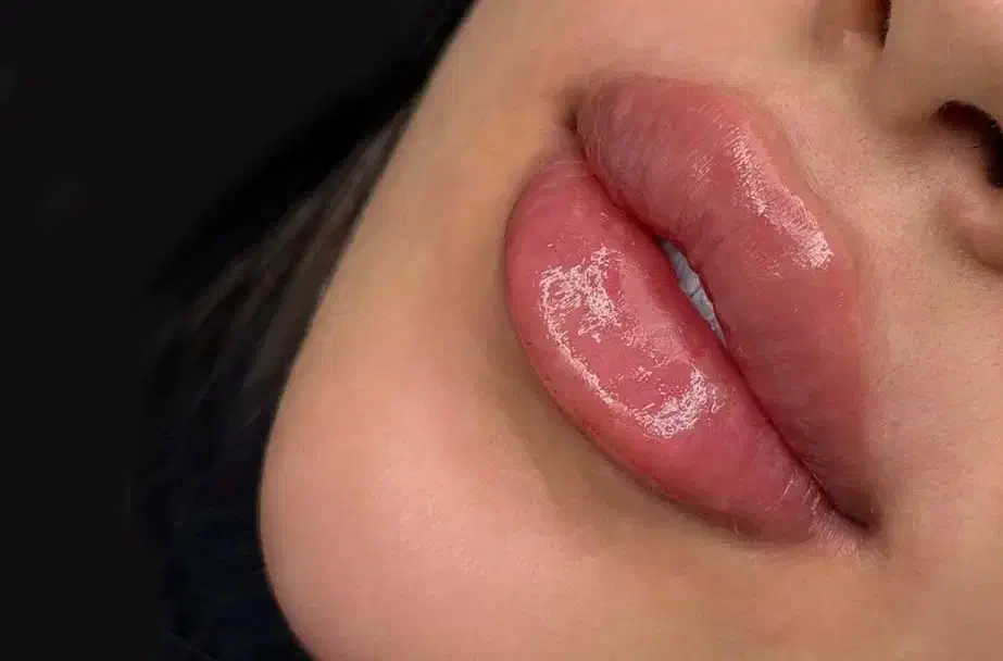 تزریق ژل فیلر و بوتاکس کل صورت ،ژل لب، چونه،گونه|خدمات آرایشگری و زیبایی|مشهد, ادیب نیشابوری (شهرک غرب)|دیوار