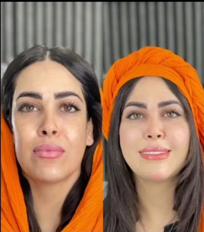 تزریق ژل و فیلر لب،گونه،چانه(جشنواره)درمطب فقط499ت|خدمات آرایشگری و زیبایی|اصفهان, باغ زیار|دیوار