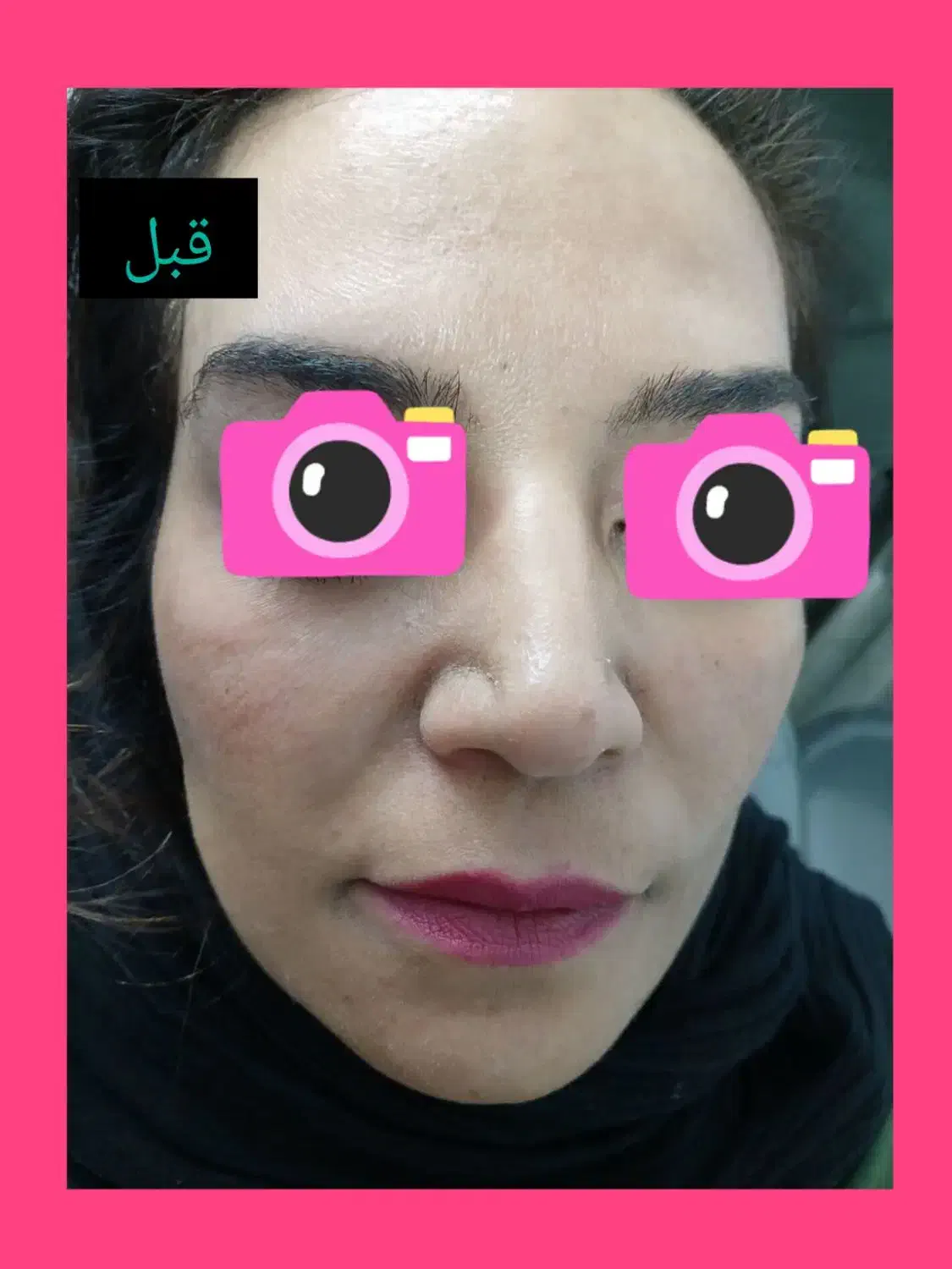 مزو میکرو نیدلینگ ،جوانسازی|خدمات آرایشگری و زیبایی|همدان, |دیوار