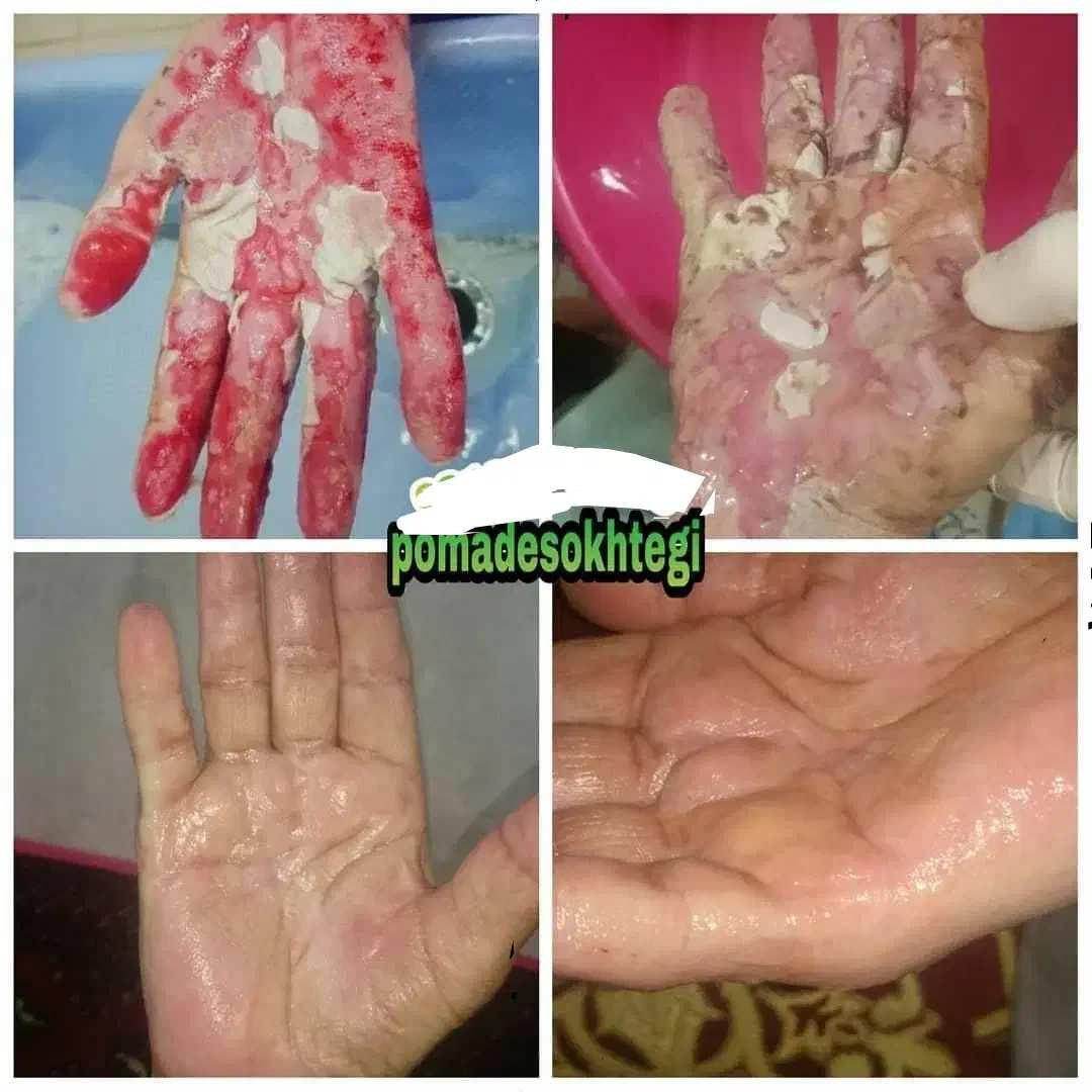 پمادسوختگی قلعه نوخرقان|آرایشی، بهداشتی، درمانی|شیراز, طلاب|دیوار