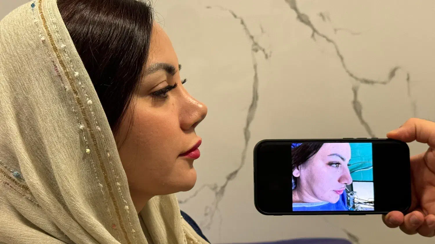 جشنواره تخفیفی لیپوماتیک بلفاروپلاستی و لیپوبازو|خدمات آرایشگری و زیبایی|تهران, ونک|دیوار