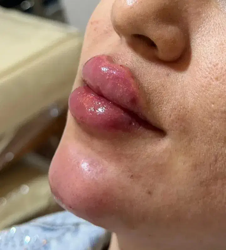 فیلر و بوتاکس پرسینگ چال لپ...|خدمات آرایشگری و زیبایی|قرچک, شهرک گلها|دیوار
