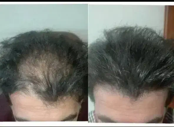 قطع مشکلات مربوط به ریزش مو|آرایشی، بهداشتی، درمانی|تهران, شهرک آزمایش|دیوار