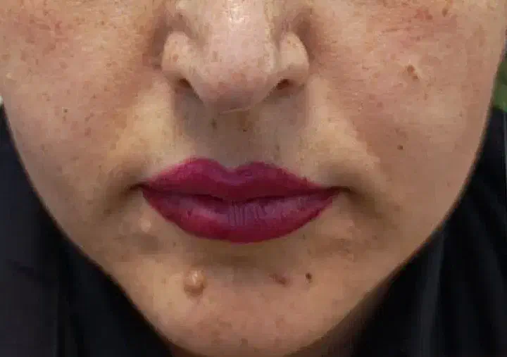 برداشتن انواع خال و لک و کک و مک|خدمات آرایشگری و زیبایی|نورآباد, |دیوار