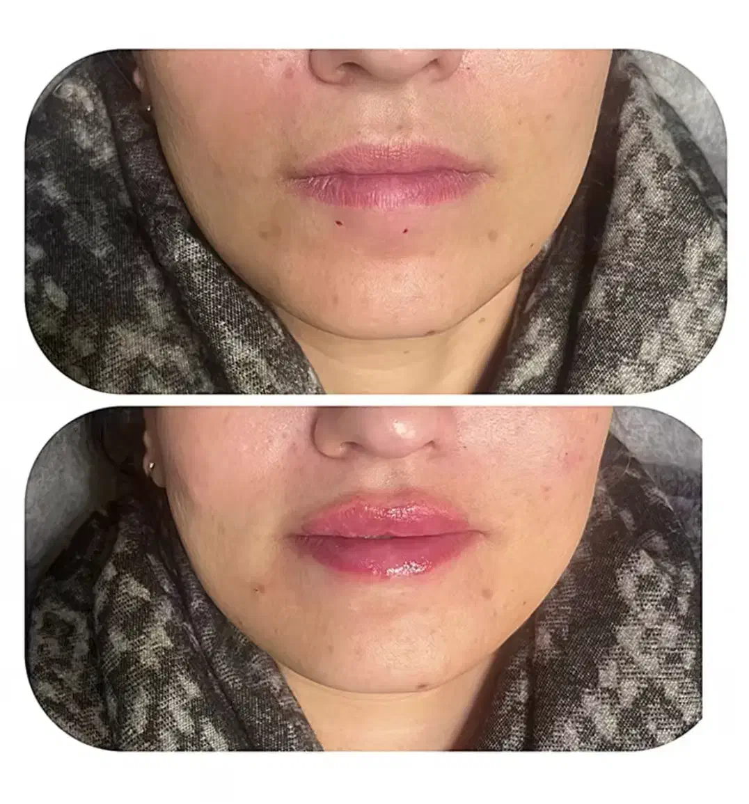 تزریق ژل و بوتاکس|خدمات آرایشگری و زیبایی|امیدیه, |دیوار