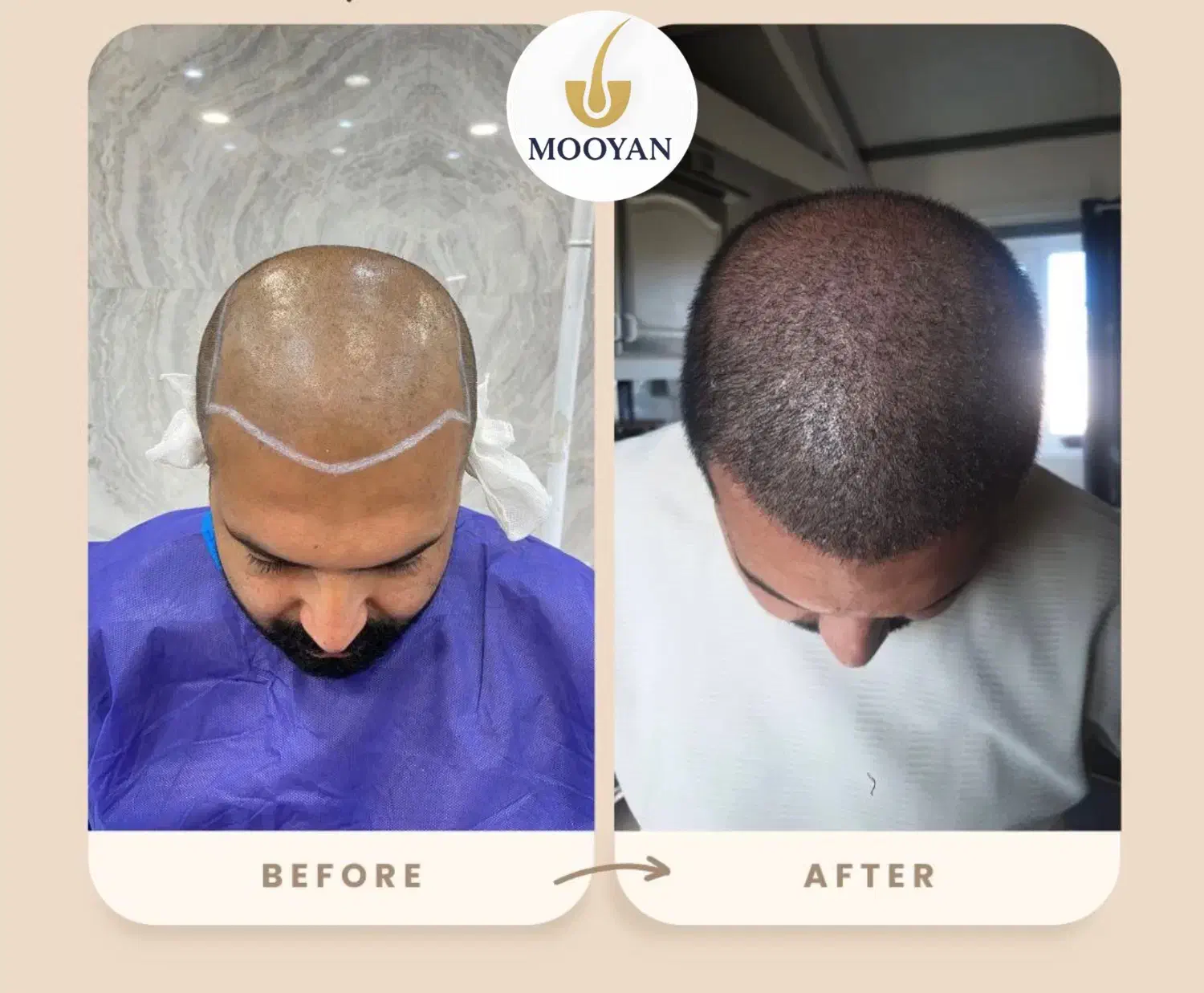 کاشت مو فقط با پرداخت ۱۰ میلیون|خدمات آرایشگری و زیبایی|تهران, جردن|دیوار