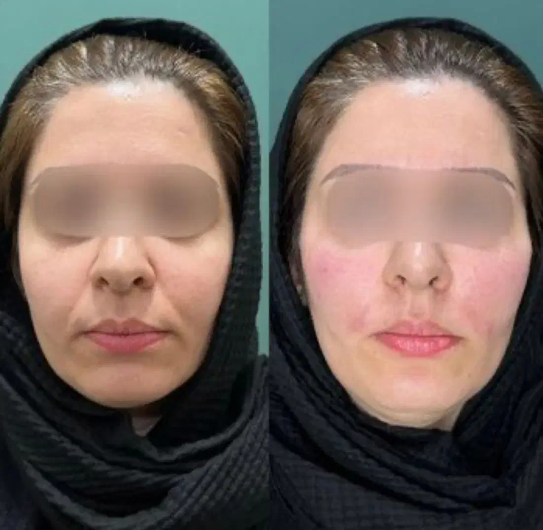 هایفوتراپی در مطب پزشک با قیمتی باورنکردنی|خدمات آرایشگری و زیبایی|مشهد, چهارچشمه|دیوار