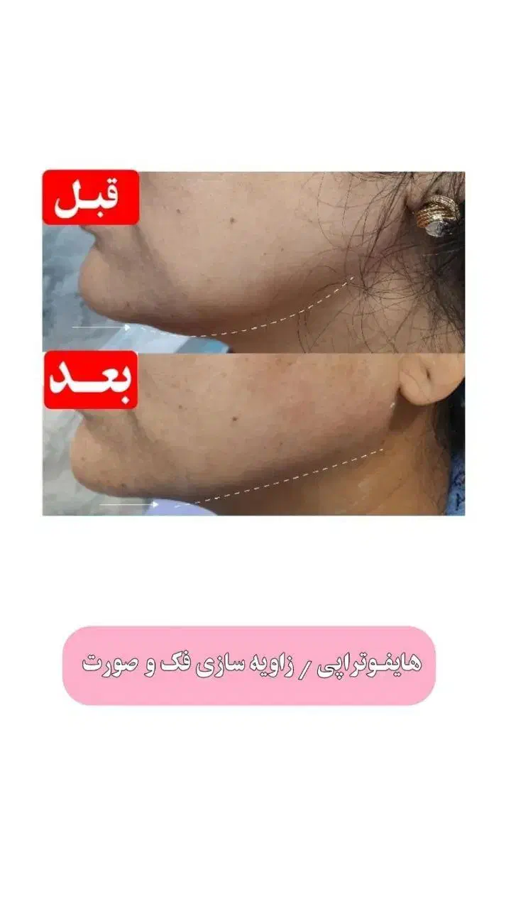 هایفو صورت۹۹۹هزارتومان|خدمات آرایشگری و زیبایی|اهواز, اهواز|دیوار
