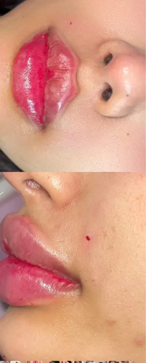 تزریق ژل لب و مادلینگ کامل صورت ب روش روسی وعربی|خدمات آرایشگری و زیبایی|قرچک, زیبا شهر|دیوار