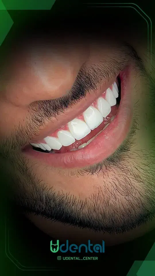 کامپوزیت، لمینت، ایمپلنت اقساط ویژه|خدمات آرایشگری و زیبایی|ایلام, |دیوار