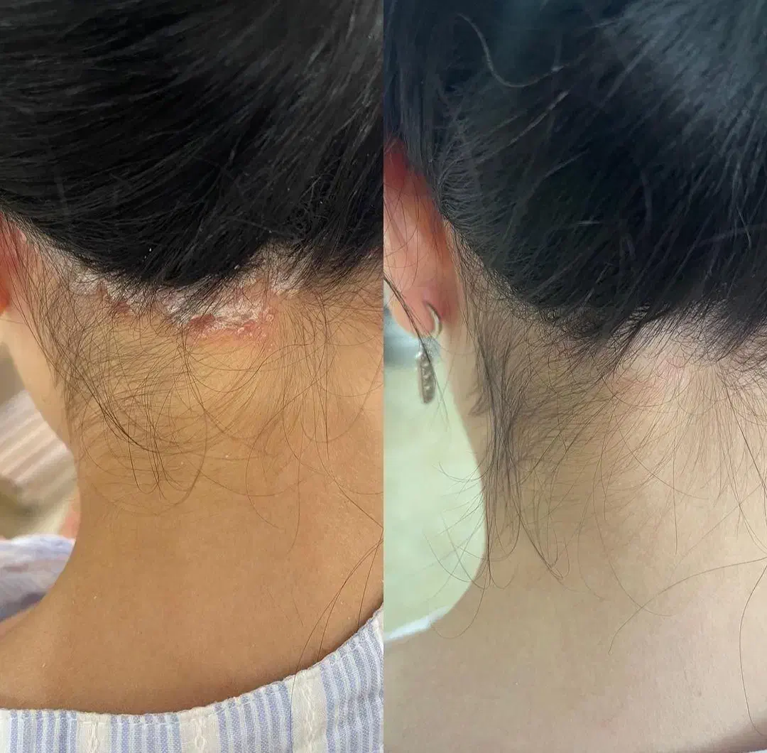 بدون برگشت و دائمی درمان بیماری پوستی|خدمات آرایشگری و زیبایی|گنبد کاووس, |دیوار