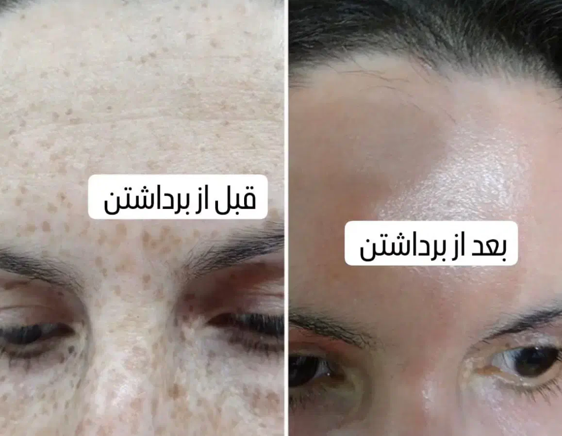 با یک جلسه کک و مکا حذف کن|خدمات آرایشگری و زیبایی|خرم‌آباد, |دیوار