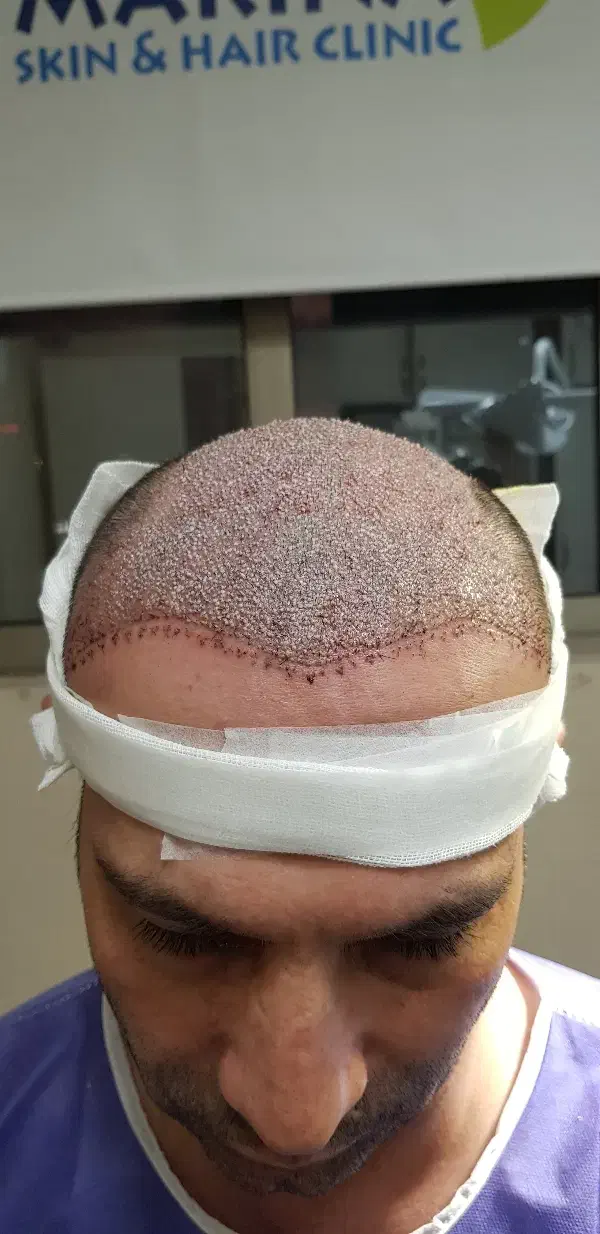 جشنواره کاشت مو دکتر راکعی .اقساط ۱۲ ماهه بدون سود|خدمات آرایشگری و زیبایی|اراک, |دیوار