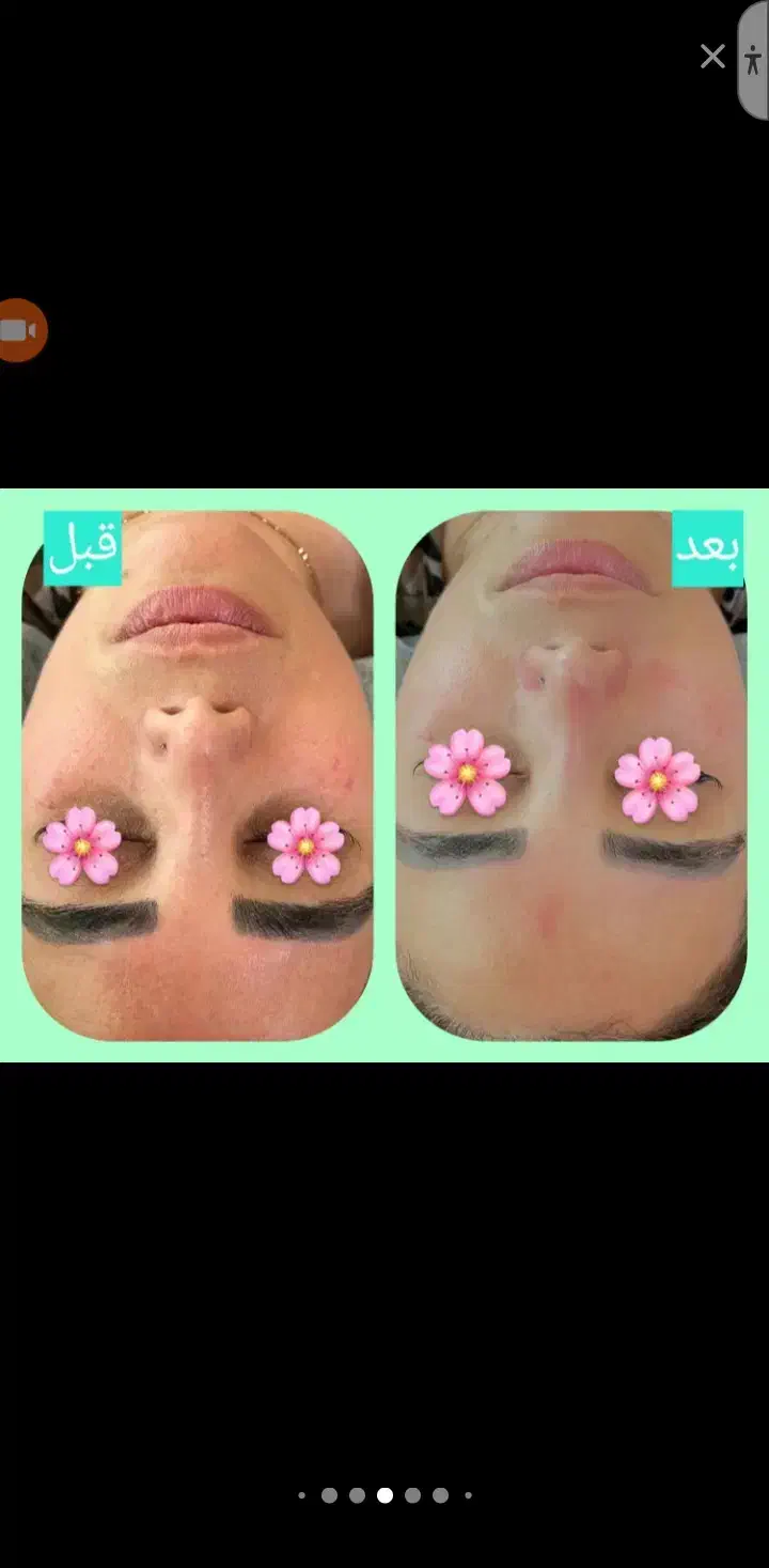 ژل وبوتاکس|خدمات آرایشگری و زیبایی|اهواز, پردیس دو|دیوار