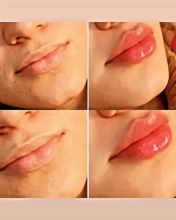 ژل و بوتاکس|خدمات آرایشگری و زیبایی|اهواز, شهرک اکباتان|دیوار