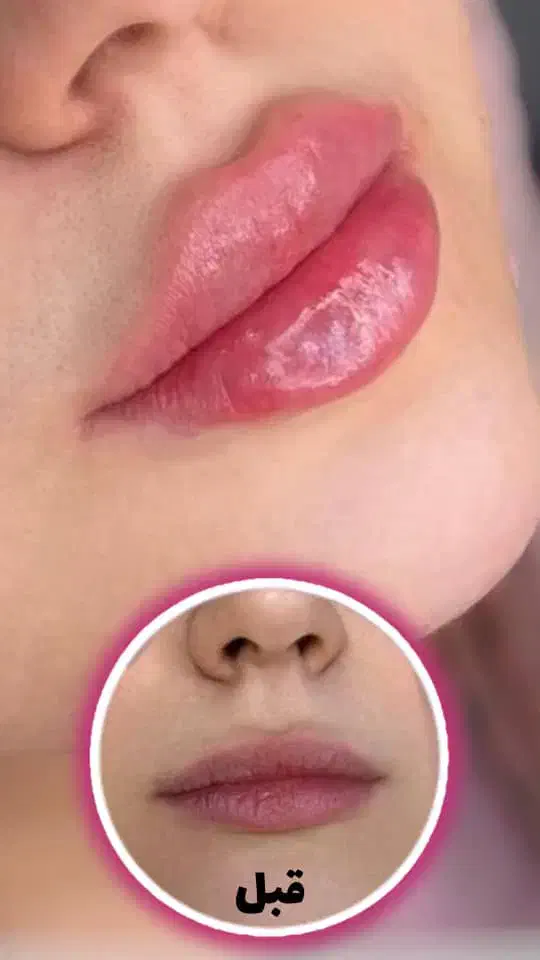 جشنواره تزریق ژل ۳۸۰ هزاروبوتاکس توسط کادردرمان|خدمات آرایشگری و زیبایی|اندیمشک, |دیوار