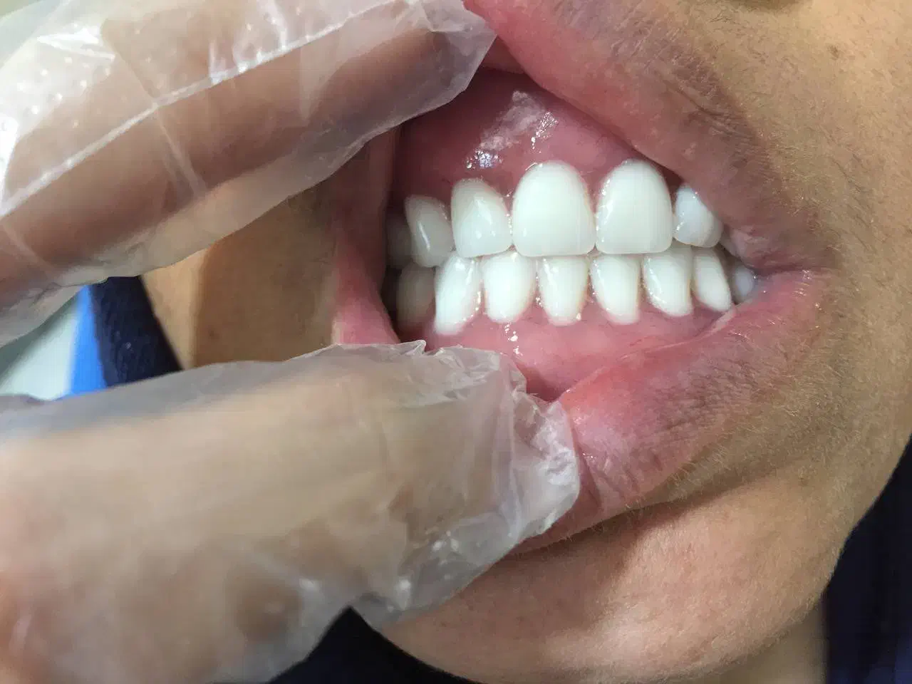 ساخت دندان مصنوعی|آرایشی، بهداشتی، درمانی|گلستان (تهران), |دیوار