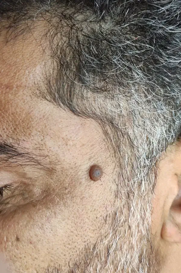 خالبرداری ، حذف گوشت اضافه و منگوله های پوستی/کیش|خدمات آرایشگری و زیبایی|کیش, |دیوار