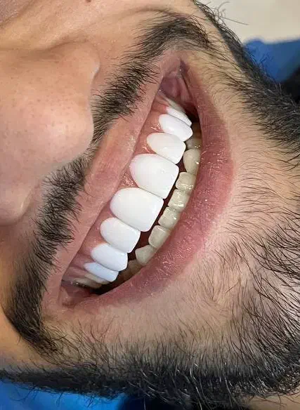 کامپوزیت دندان بابل|خدمات آرایشگری و زیبایی|امیرکلا, |دیوار