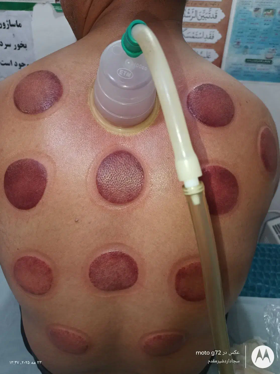 حجامت زالو فصد|آرایشی، بهداشتی، درمانی|یاسوج, |دیوار