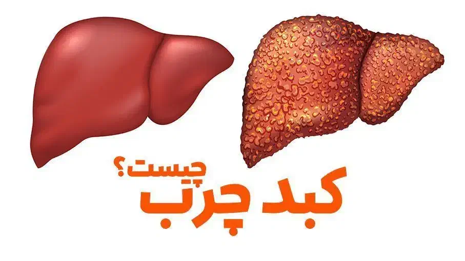 کبدچرب درمان شد*گیاهی*|آرایشی، بهداشتی، درمانی|ابهر, |دیوار