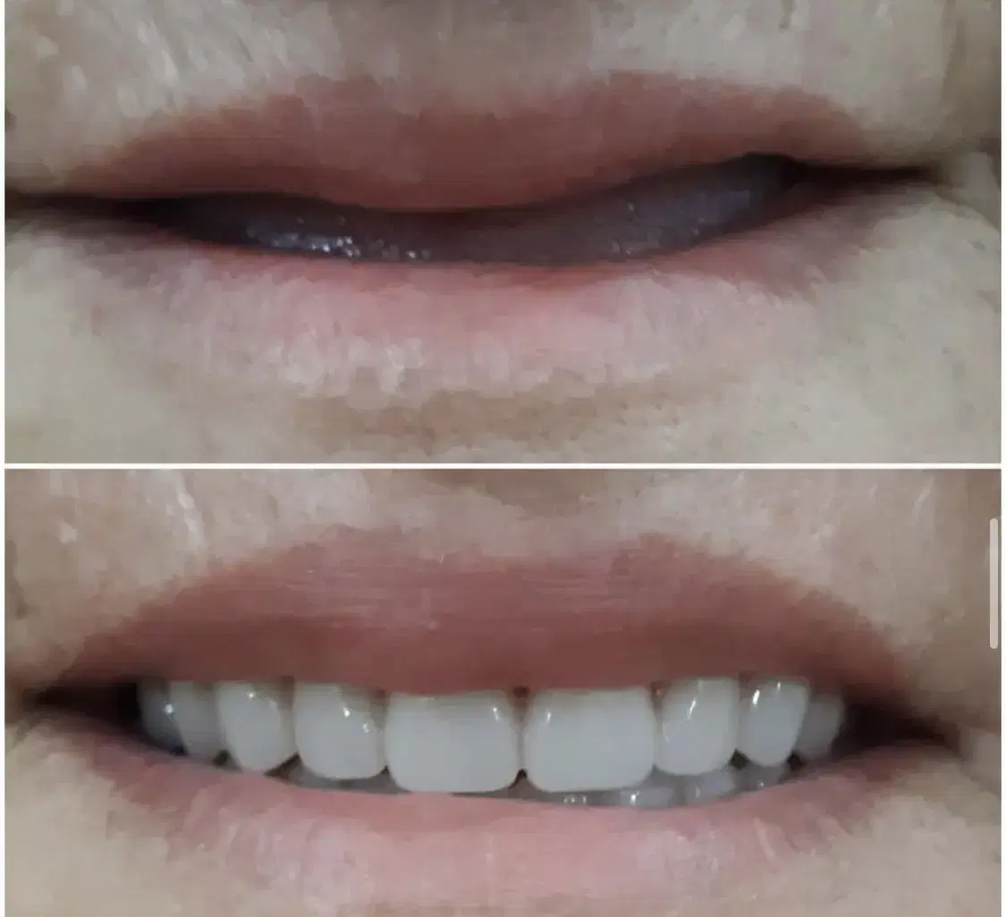 ساخت دندان مصنوعی طبیعی واقتصادی توسط پروتزیست|خدمات زیبایی و سلامت|کرج, گلشهر|دیوار