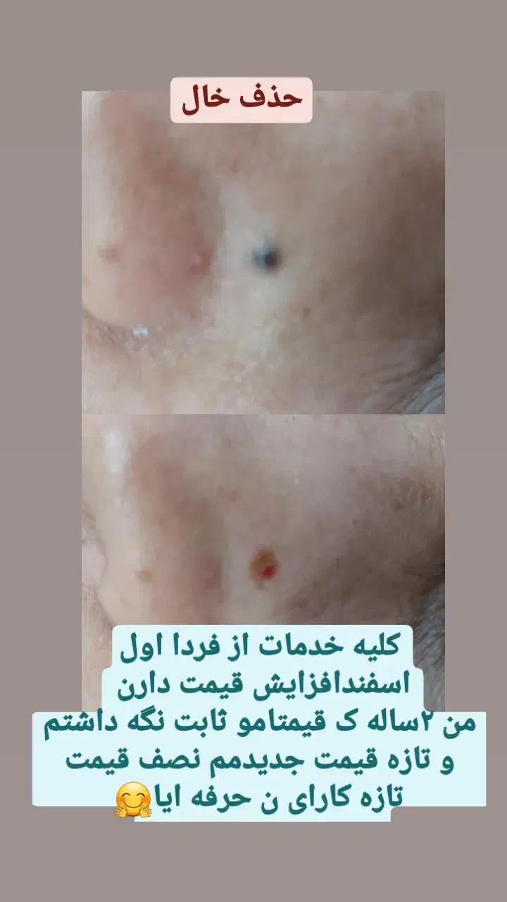 لیزر موهای زائد با روشن کننده جدا|خدمات آرایشگری و زیبایی|بیرجند, |دیوار