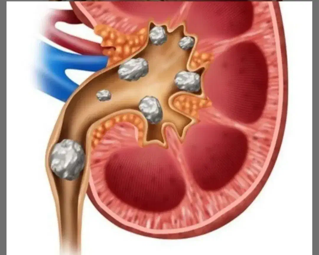 درمان سنگ کلیه|آرایشی، بهداشتی، درمانی|سنندج, |دیوار