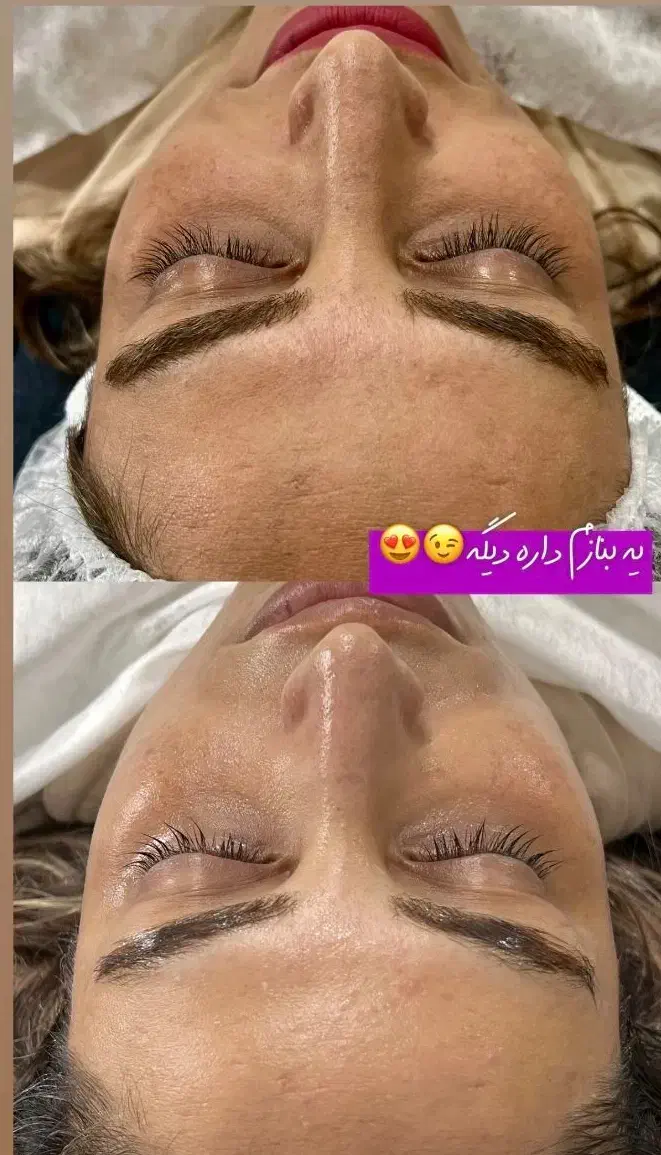 پاکسازی،فیشال درمان مشکلات پوستی|خدمات آرایشگری و زیبایی|زابل, |دیوار