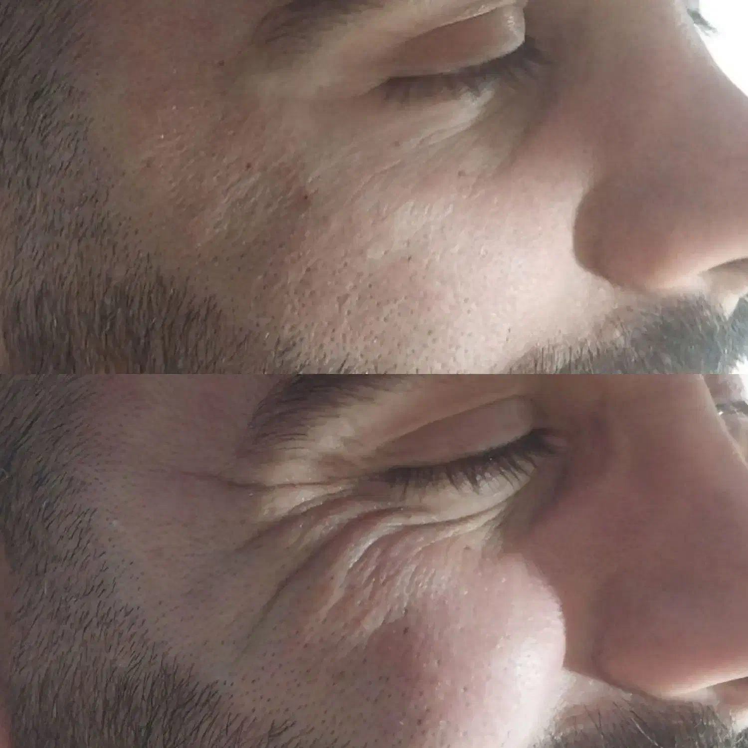 آف ژل و بوتاکس .مزو وآنزیم...|خدمات آرایشگری و زیبایی|ایذه, |دیوار