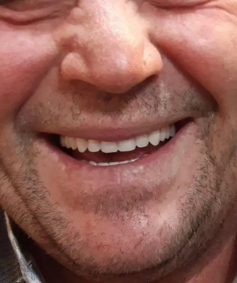 ترمیم عصب کشی روکش کامپوزیت زیبایی|خدمات آرایشگری و زیبایی|اردبیل, |دیوار