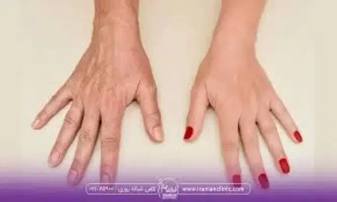 مدل فیشال دست و آبرسانی و جوان سازی|خدمات آرایشگری و زیبایی|شیراز, کاراندیش|دیوار