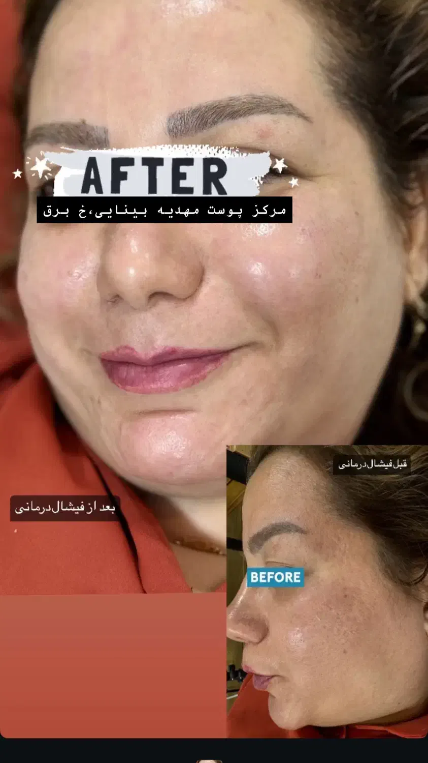 فیشال تخصصی و درمانی با برند کلینیکی کره جنوبی|خدمات آرایشگری و زیبایی|بندر کنگان, |دیوار