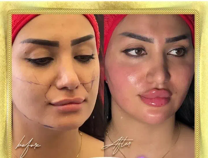 آموزش فیشیال،ژل بوتاکس برای آقاها،خانم هفده شهریور|خدمات آموزشی|تبریز, |دیوار
