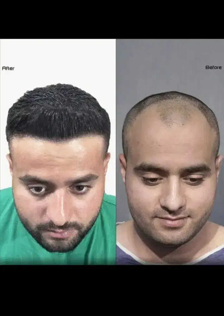 اقساطی کاشت مو تضمینی/کاشت ابرو کاشت|خدمات آرایشگری و زیبایی|تهران, چیذر|دیوار