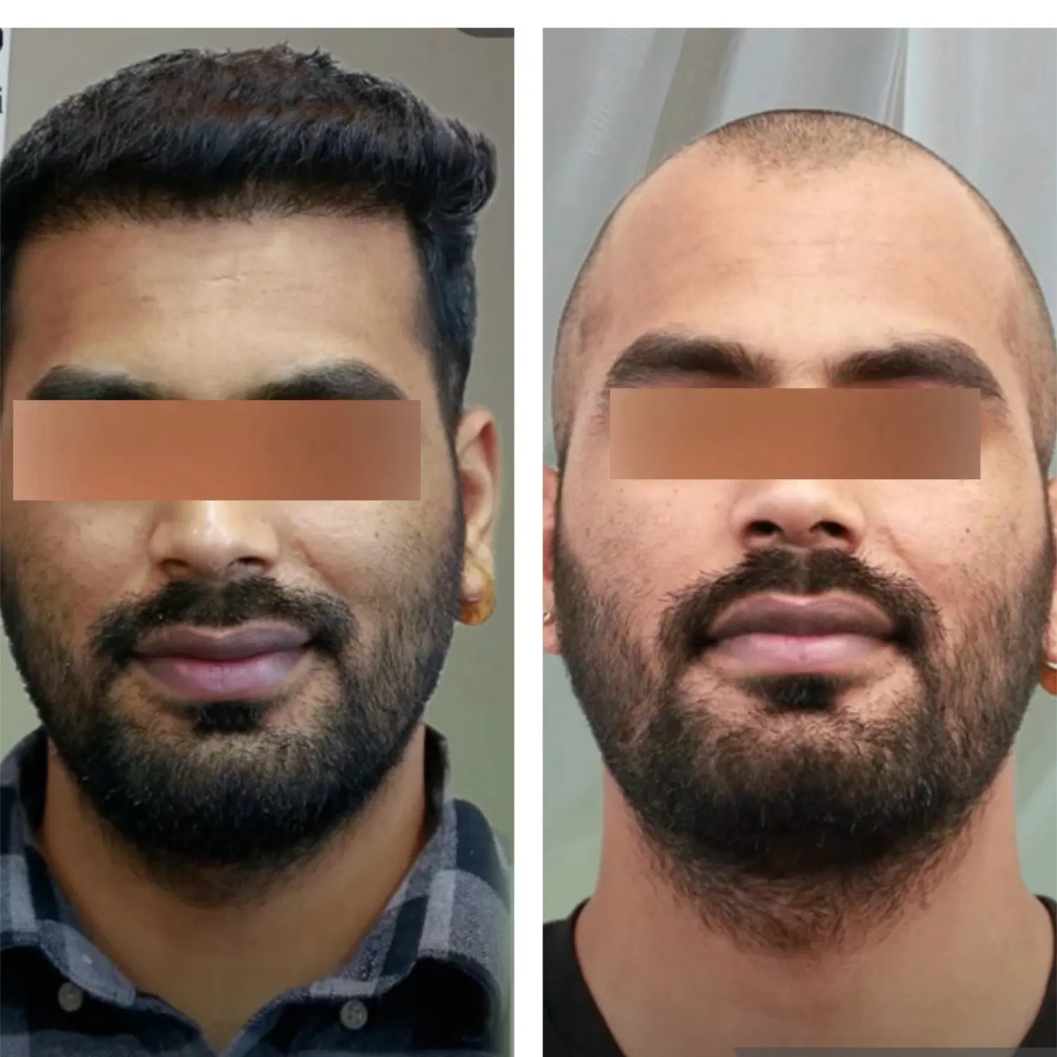 کاشت مو شیرازی vip فول تراکم تعرفه استثنایی|خدمات زیبایی و سلامت|تهران, پاسداران|دیوار