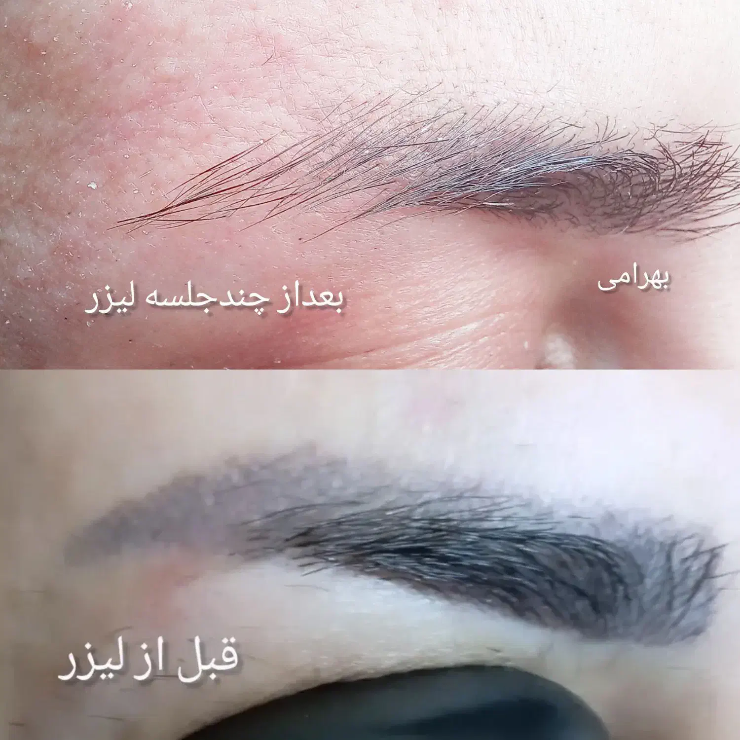 پاک کردن تاتوبالیزرکیوسوییچ|خدمات آرایشگری و زیبایی|مشهد, گلشور|دیوار