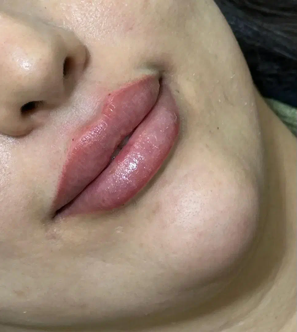 تزریق ژل و بوتاکس و پی ارپی و مزوتراپی و لیزر مو|خدمات آرایشگری و زیبایی|بوشهر, |دیوار